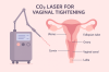 CO2 laser vaginal tightening เลเซอร์กระชับน้องสาว มินิรีแพร์น้องสาว เพิ่มน้ำหล่อลื่น