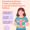 iud