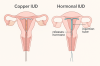 บริการใส่ห่วงคุมกำเนิด (IUD) ห่วงทองแดง/ห่วงฮอร์โมน