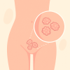 หูดหงอนไก่ HPV genital warts 
