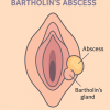 ฝีที่ต่อมบาร์โธลิน ฝีที่แคม ฝีที่ต่อมบาร์โธลิน ฝีที่แคม
