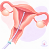 ตรวจชิ้นเนื้อ ตรวจชิ้นเนื้อโพรงมดลูก ตัดชิ้นเนื้อ endometrial sampling biopsy