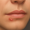 Herpes Simplex Virus (HSV) : Never Goes Away But Remissible