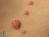 Molluscum contagiosum — How is it transmitted? Dangerous? Cause cancer? Molluscum contagiosum — How is it transmitted? Dangerous? Cause cancer?