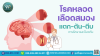 โรคหลอดเลือดสมอง ปัจจัยเสี่ยงที่หลีกเลี่ยงได้ โรคหลอดเลือดสมอง ปัจจัยเสี่ยงที่หลีกเลี่ยงได้