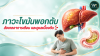 ภาวะไขมันพอกตับ สังเกตอาการเตือน และดูแลเบื้องต้น ภาวะไขมันพอกตับ สังเกตอาการเตือน และดูแลเบื้องต้น