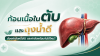 ก้อนเนื้อในตับและถุงน้ำดี อันตรายแค่ไหน? ต้องผ่าตัดหรือไม่ และผ่าพร้อมกันได้ไหม ก้อนเนื้อในตับและถุงน้ำดี อันตรายแค่ไหน? ต้องผ่าตัดหรือไม่ และผ่าพร้อมกันได้ไหม