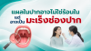 แผลในปากไม่หาย อาจเป็นสัญญาณมะเร็งช่องปาก แผลในปากไม่หาย อาจเป็นสัญญาณมะเร็งช่องปาก
