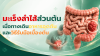 มะเร็งลำไส้ส่วนต้น เมื่อทางเดินอาหารอุดตัน สัญญาณเตือนที่ควรรู้ และวิธีรับมือเบื้องต้น มะเร็งลำไส้ส่วนต้น เมื่อทางเดินอาหารอุดตัน สัญญาณเตือนที่ควรรู้ และวิธีรับมือเบื้องต้น
