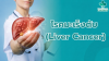 สาเหตุการเกิดมะเร็งตับ สาเหตุการเกิดมะเร็งตับ