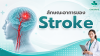 ลักษณะอาการของโรคหลอดเลือดสมอง (stroke) ลักษณะอาการของโรคหลอดเลือดสมอง (stroke)