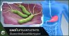 แบคทีเรีย H.Pylori ก่อโรคกระเพาะอาหาร แบคทีเรีย H.Pylori ก่อโรคกระเพาะอาหาร
