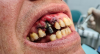 Bad result from Cheap Implant