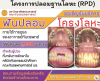 ขอเชิญรับบริการ ฟันปลอม "โครงโลหะ" ภายใต้การดูแลของอาจารย์ทันตแพทย์ ขอเชิญรับบริการ ฟันปลอม "โครงโลหะ" ภายใต้การดูแลของอาจารย์ทันตแพทย์