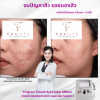 รีวิว Vbeam Laser