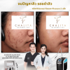 รีวิว Vbeam Laser