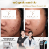 รีวิว Vbeam Laser