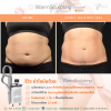 รีวิว Sculpsure