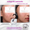 รีวิว Vbeam Laser