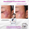 รีวิว Vbeam Laser