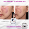 รีวิว Vbeam Laser