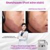 รีวิว Vbeam Laser