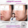 รีวิว Vbeam Laser