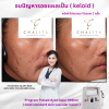 รีวิว Vbeam Laser