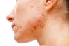 Acne: Causes and Treatments