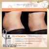 Sculpsure