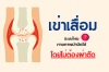 เข่าเสื่อม ระยะไหนกายภาพบำบัดได้? โดยไม่ต้องผ่าตัด เข่าเสื่อม ระยะไหนกายภาพบำบัดได้? โดยไม่ต้องผ่าตัด
