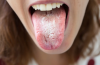 Can You Get Chlamydia in Your Mouth?