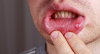 Can You Get Chlamydia in Your Mouth? Can You Get Chlamydia in Your Mouth?