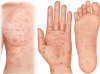 Syphilis