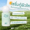 Anti Acne Serum