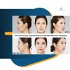 Jenis-Jenis Operasi Plastik yang Populer di Korea
