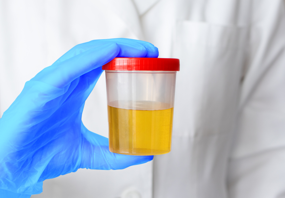 URINE ORGANIC ACID TEST ตรวจปัสสาวะถึงกรดอินทร์บ่งชี้สุขภาพ mediscicenter