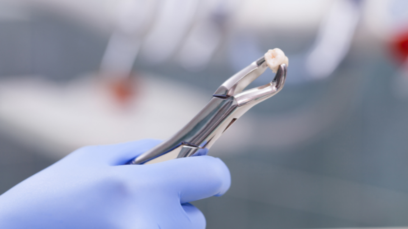 How Many Types of Impacted Wisdom Teeth Are There? Which Ones Are ...