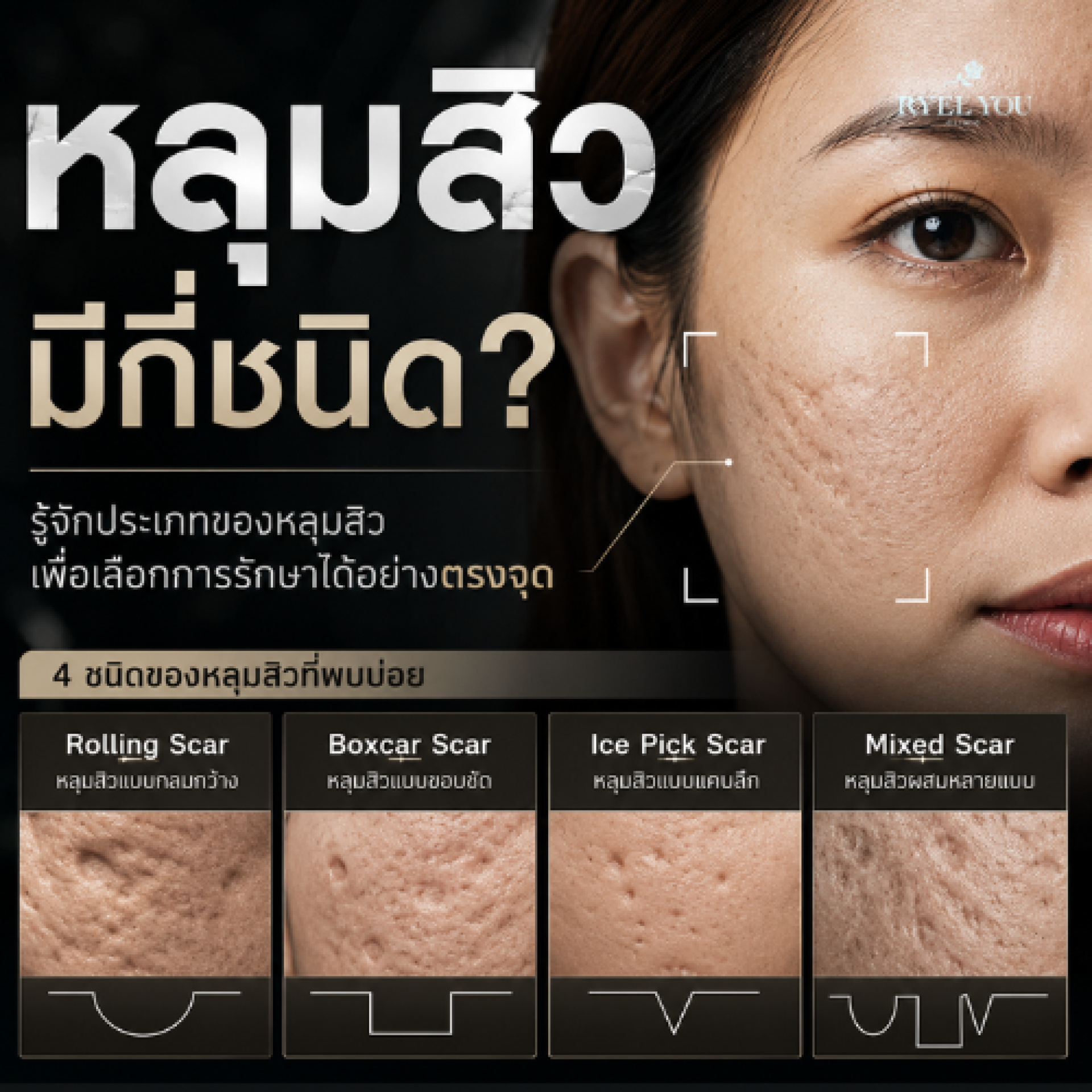 ชนิดของหลุมสิว ชนิดของหลุมสิว