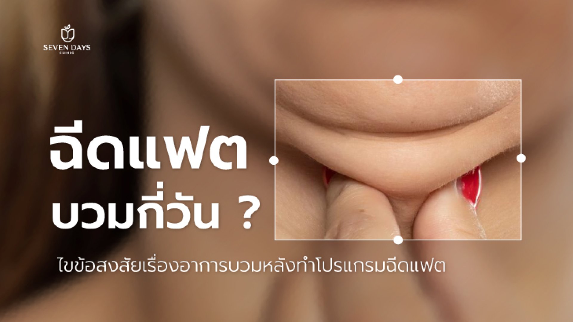 ฉีดแฟตบวมกี่วัน? ฉีดแฟตบวมกี่วัน?