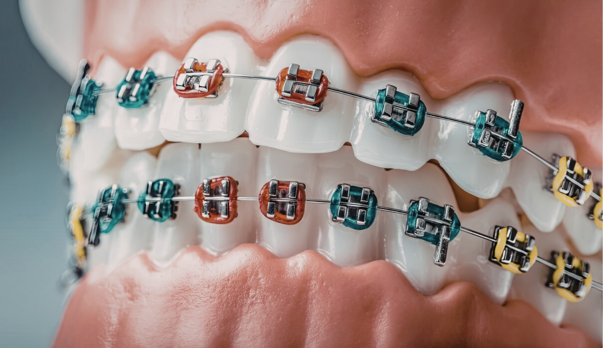 Best Braces Colors Guide: Brighten Your Smile and Boost Confidence