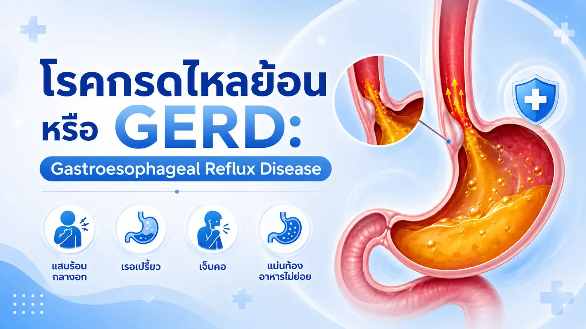 กรดไหลย้อน, เซเปี้ยนซ์, sapiens, อายุรกรรม กรดไหลย้อน, เซเปี้ยนซ์, sapiens, อายุรกรรม