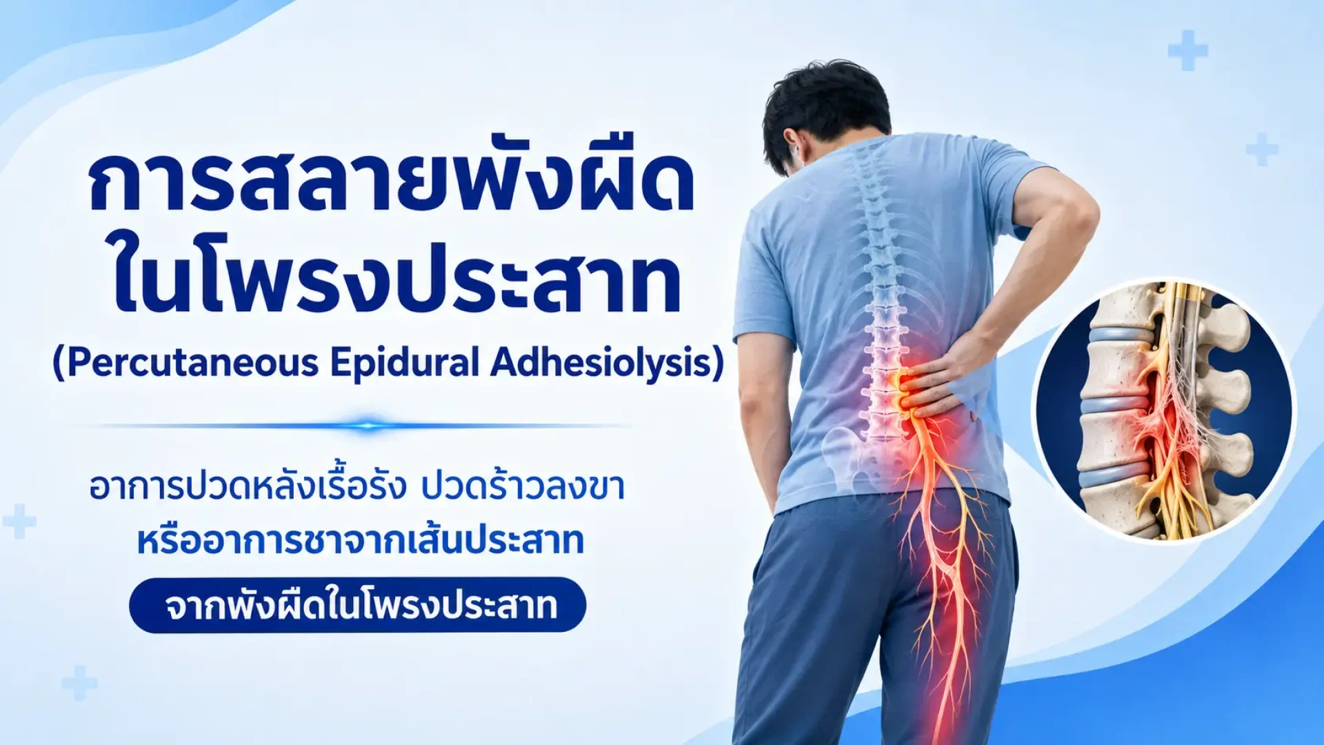 อาการปวดหลังเรื้อรัง, ปวดร้าวลงขา, อาการชาจากเส้นประสาท, พังผืดในโพรงประสาท อาการปวดหลังเรื้อรัง, ปวดร้าวลงขา, อาการชาจากเส้นประสาท, พังผืดในโพรงประสาท