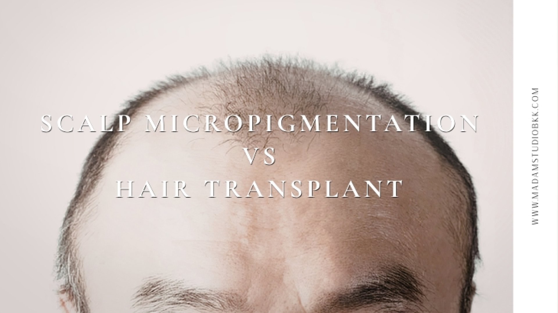 Scalp Micropigmentation vs Hair Transplant ปลูกผม Scalp Micropigmentation vs Hair Transplant ปลูกผม