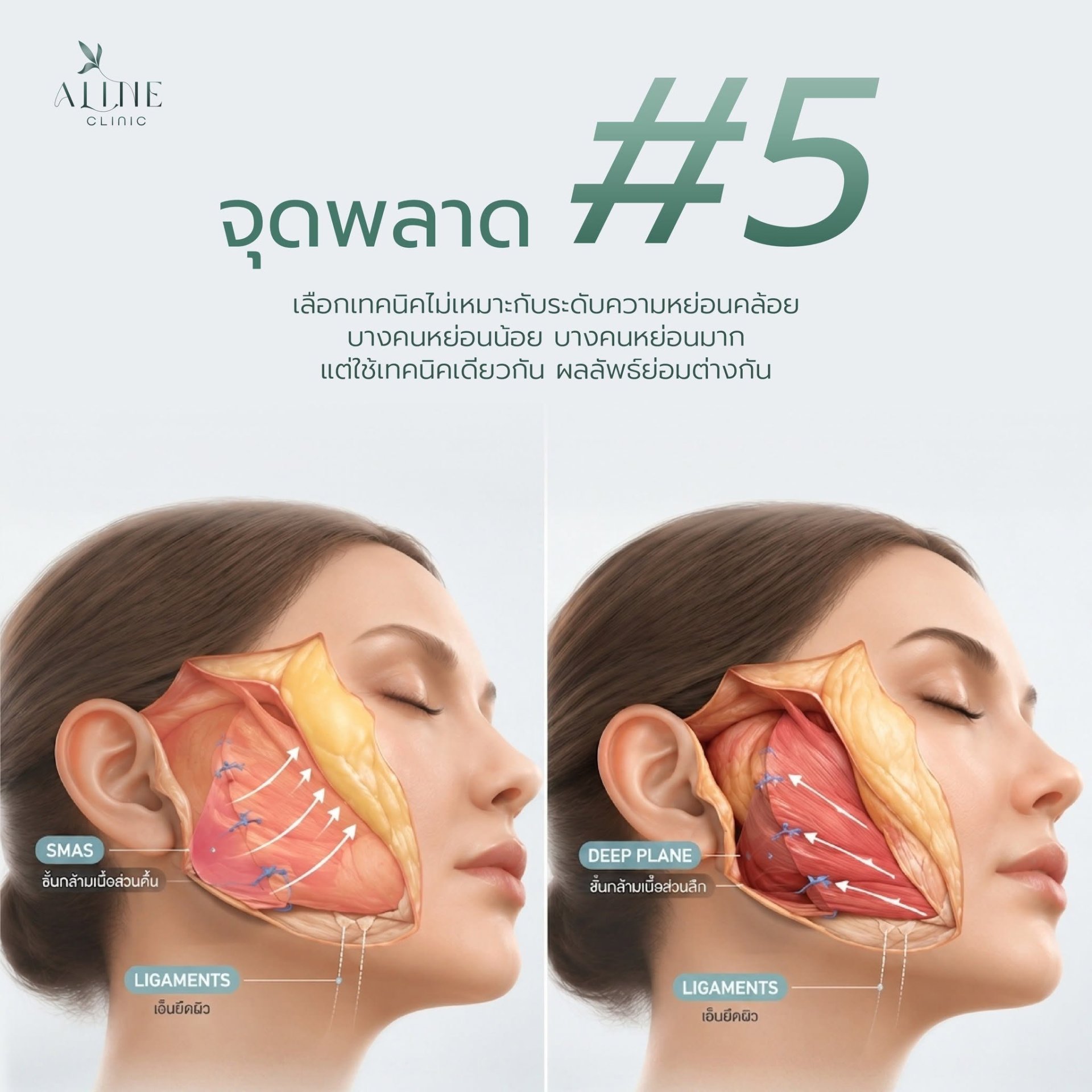 ดึงหน้า deep plane facelift โคราช ดึงหน้า deep plane facelift โคราช