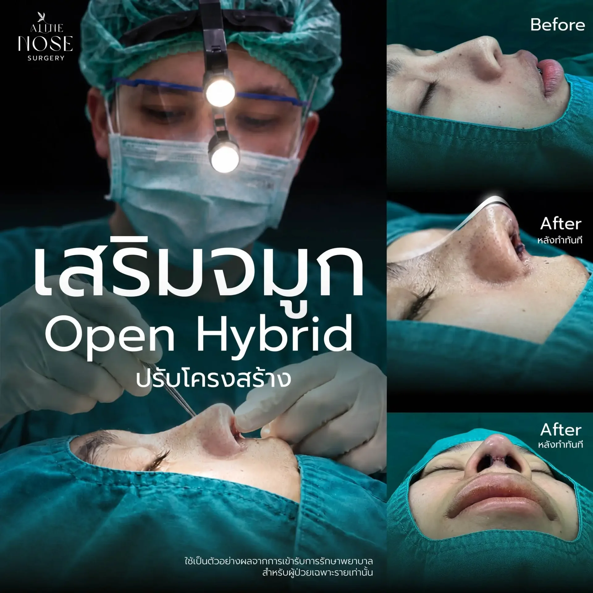 เสริมจมูกโอเพ่น open hybrid เสริมจมูกโอเพ่น open hybrid