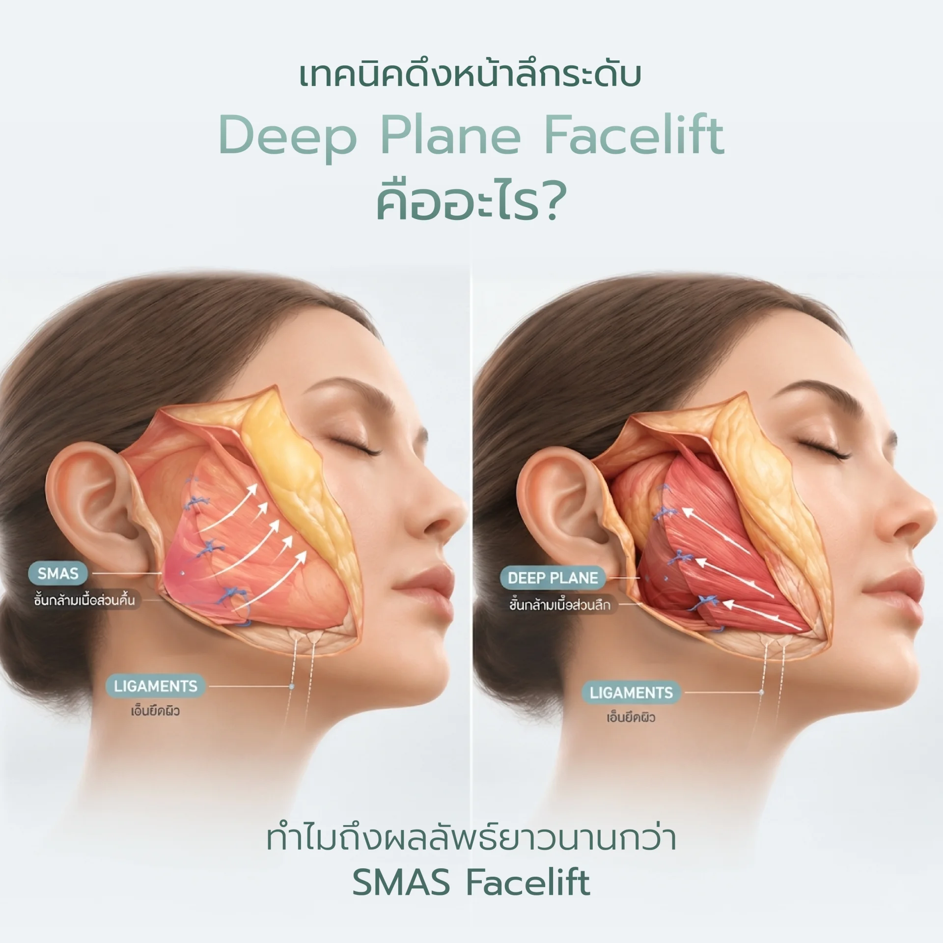 ดึงหน้า Deep Plane คืออะไร ดึงหน้า Deep Plane คืออะไร