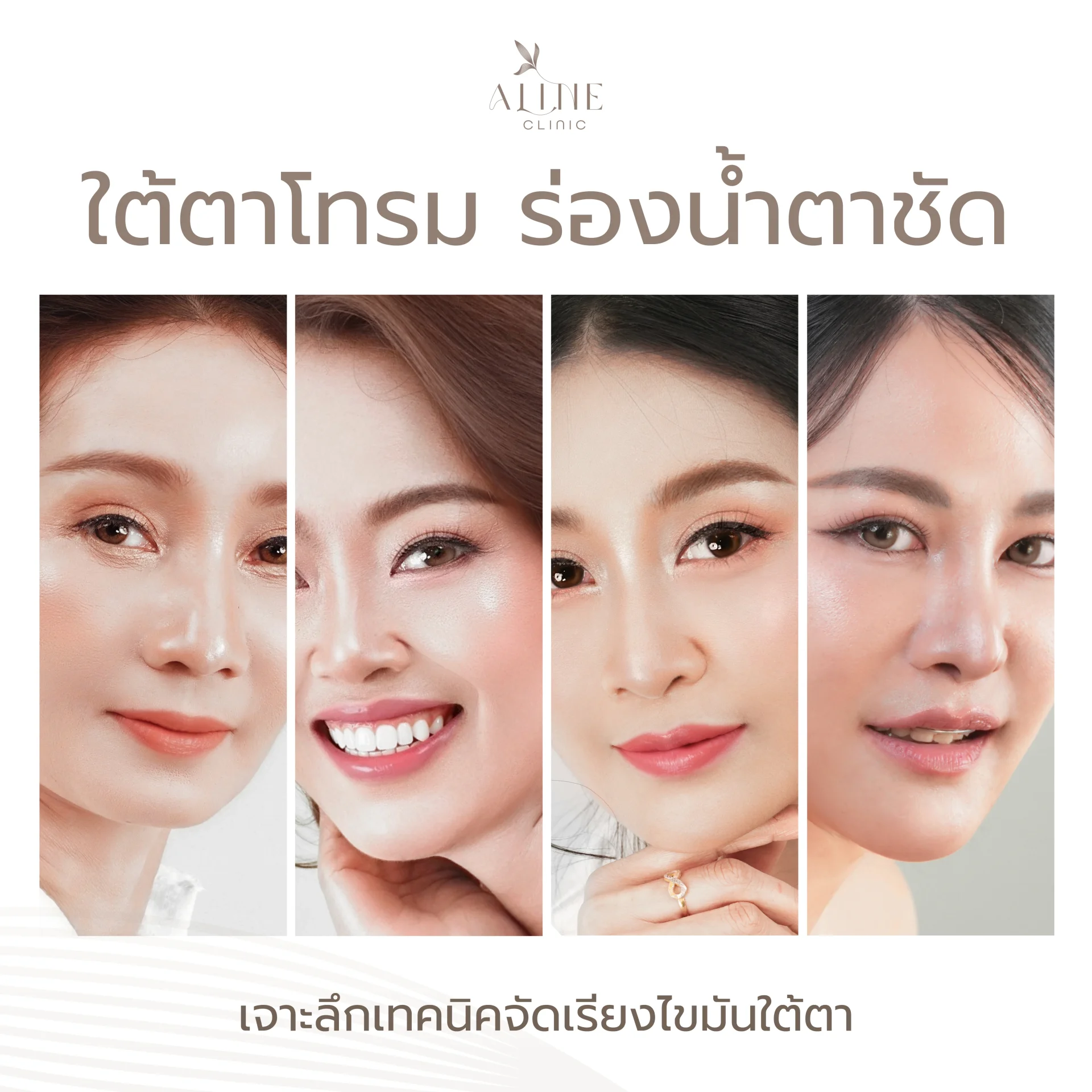 การจัดเรียงไขมันใต้ตาคืออะไร การจัดเรียงไขมันใต้ตาคืออะไร
