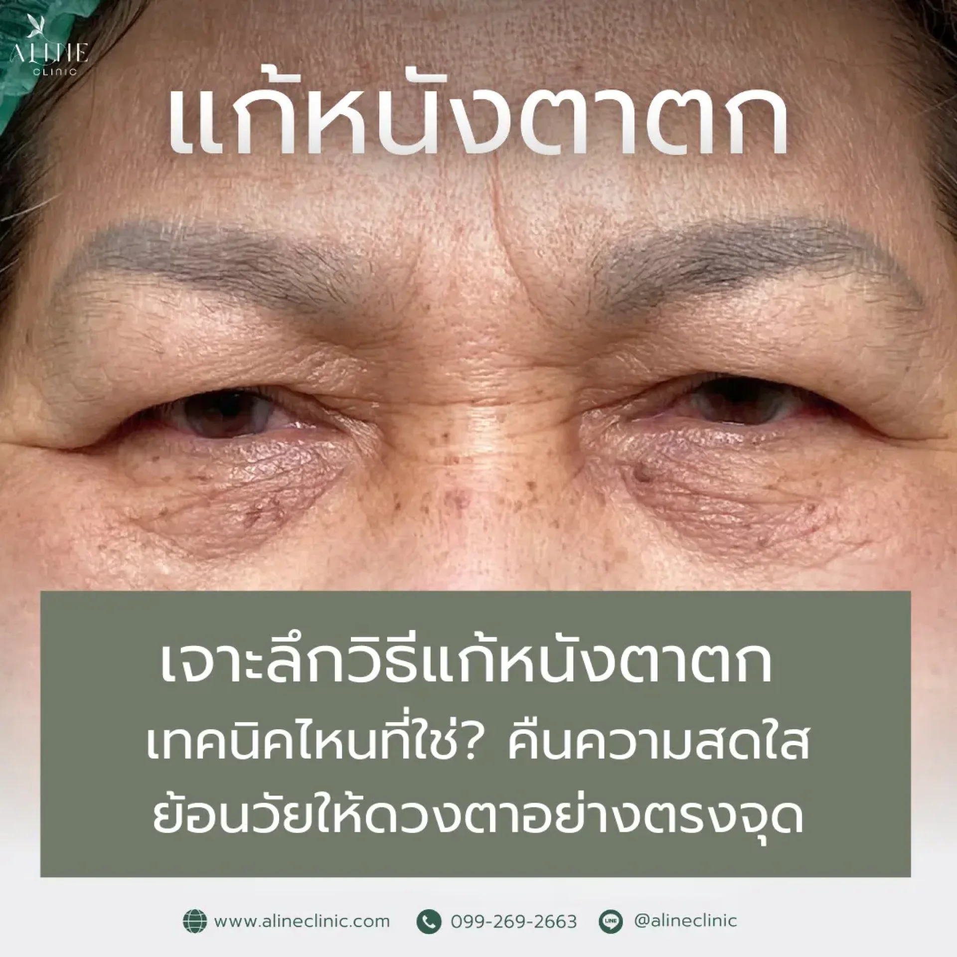 แก้หนังตาตก โคราช aline clinic แก้หนังตาตก โคราช aline clinic