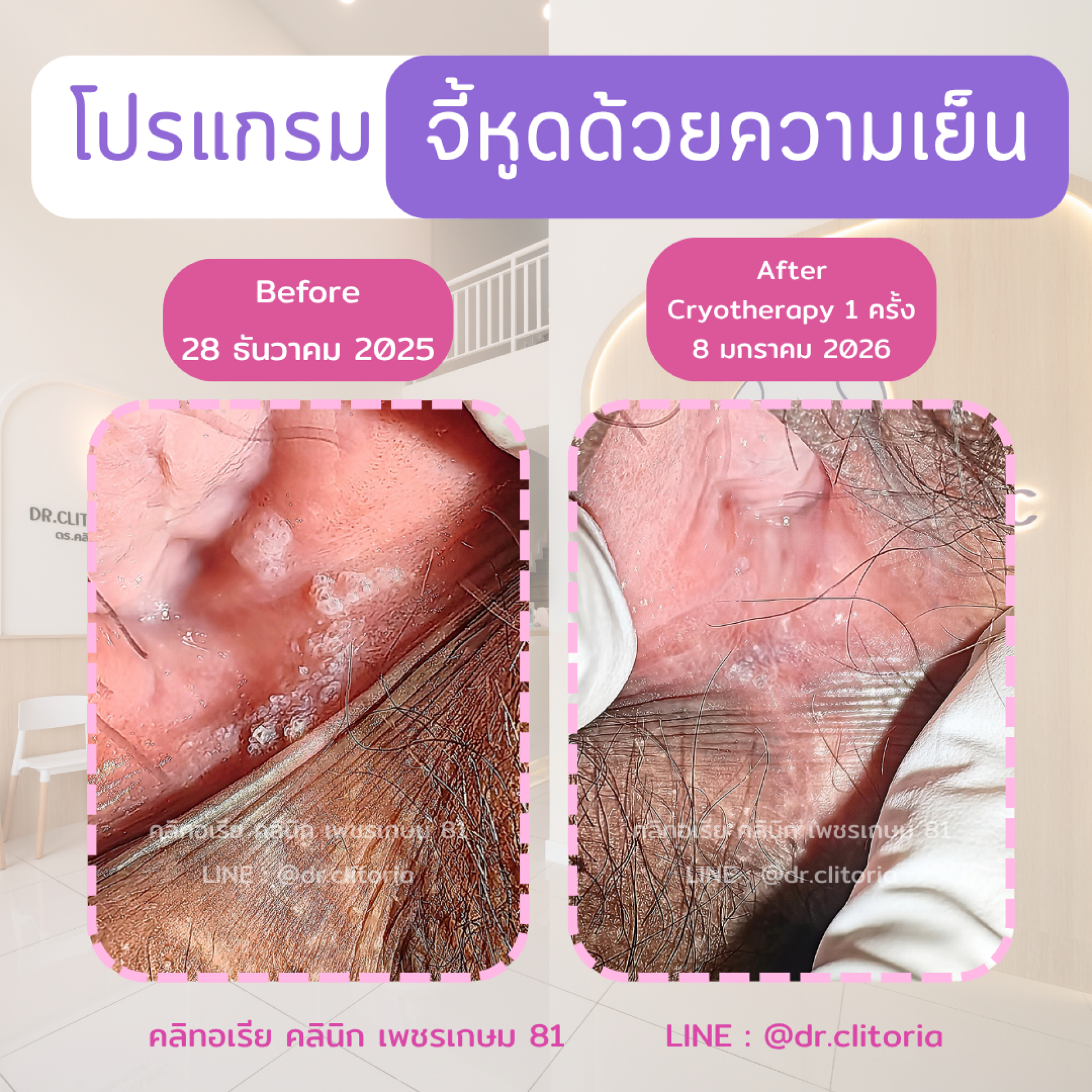 จี้หูดหงอนไก่ด้วยความเย็น จี้เย็น ไนโตรเจนเหลว รักษาหูด จี้หูด HPV คลิทอเรียคลินิก Genital warts treatment cryotherapy จี้หูดหงอนไก่ด้วยความเย็น จี้เย็น ไนโตรเจนเหลว รักษาหูด จี้หูด HPV คลิทอเรียคลินิก Genital warts treatment cryotherapy